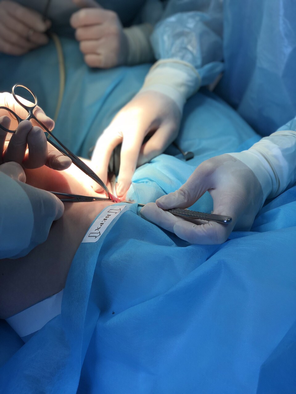 ХІРУРГІЧНЕ ЛІКУВАННЯ ВАРИКОЗУ